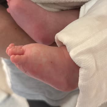 Bahçelievler Medipol’da Bebekte Tek Seferde Açılan Damar Yolu Sonrası Travma Ve Yanlış Bantlama