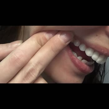 DT. Ece Akgün Nal Yanıltıcı Reklam, Hatalı Lamine Tedavisi Ve Garanti İhlali: 100.000 TL İade Talebi