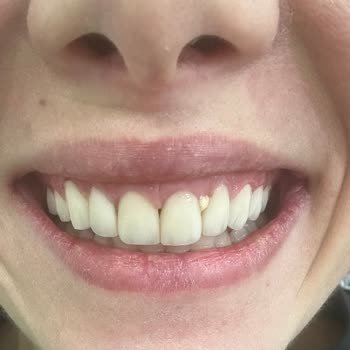 DT. Ece Akgün Nal Yanıltıcı Reklam, Hatalı Lamine Tedavisi Ve Garanti İhlali: 100.000 TL İade Talebi