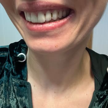 DT. Ece Akgün Nal Yanıltıcı Reklam, Hatalı Lamine Tedavisi Ve Garanti İhlali: 100.000 TL İade Talebi