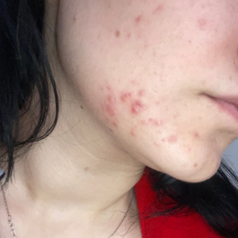 Yves Rocher Kil Maskesi Ciltte Sivilcelenme Ve Bozulmaya Neden Oldu, Ücret İadesi Talebi