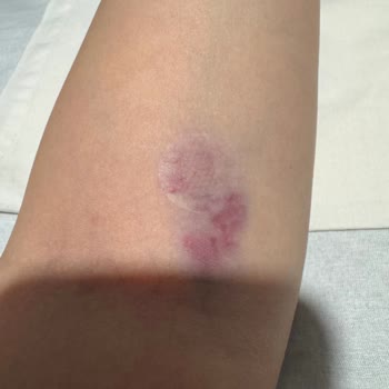 Acilde Tekrarlanan Damar Yolu Açma Başarısızlıkları Ve Saygısız Hemşire Tutumu