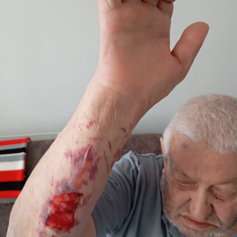 Erzurum Şehir Hastanesi Acil Servisinde Serum Yanığı Ve Yetersiz Müdahale