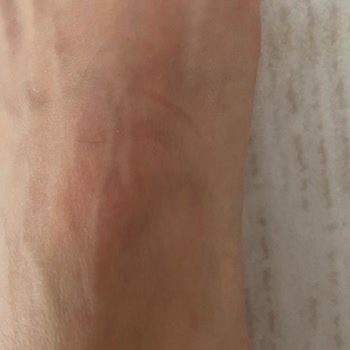 Derimod Botta Ayıplı Ürün Ve Sağlık Sorunu, İade Reddi Ve Fatura Gönderilmemesi