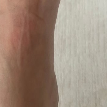 Derimod Botta Ayıplı Ürün Ve Sağlık Sorunu, İade Reddi Ve Fatura Gönderilmemesi