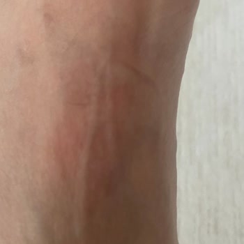 Derimod Botta Ayıplı Ürün Ve Sağlık Sorunu, İade Reddi Ve Fatura Gönderilmemesi