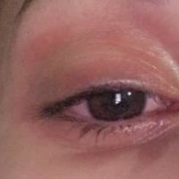 Influence Beauty Çene Bölgemde Kızarıklık Oluştu