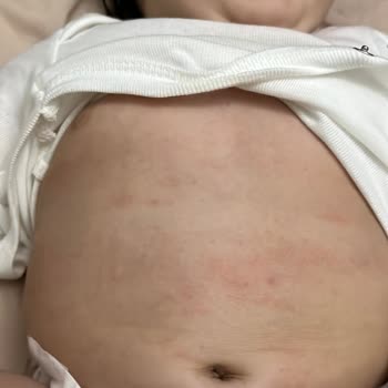 Mustela Stelatopia Kullanımından Sonra Bebekte Şiddetli Kızarıklık Ve Yara Oluştu