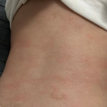 Mustela Stelatopia Kullanımından Sonra Bebekte Şiddetli Kızarıklık Ve Yara Oluştu