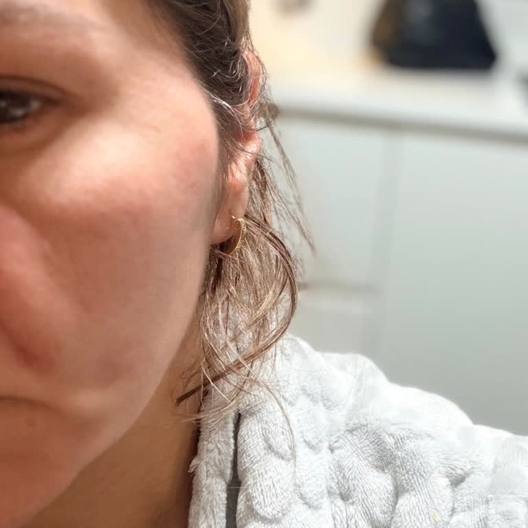 Op. Dr. Başak Çaypınar Dolgu İşlemi Sonrası Şiddetli Şişlik Ve Asimetri, Çözüm Bulunamayan Yaklaşım