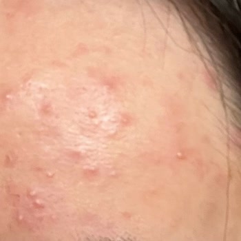 Yves Rocher Tonik Kullanımından Sonra Alnda Ani Sivilce Patlaması Ve 3500 TL Tedavi Masrafı