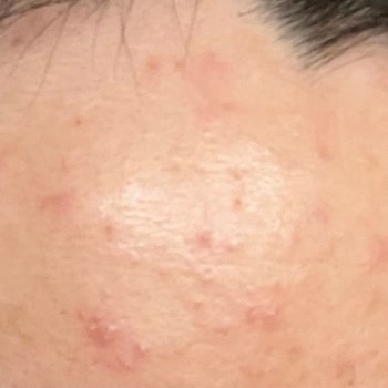 Yves Rocher Tonik Kullanımından Sonra Alnda Ani Sivilce Patlaması Ve 3500 TL Tedavi Masrafı