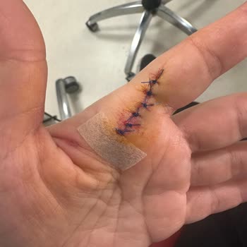 Balparmak Çıt Kapaklı Bal Kapağını Açarken Elime Kesik Geldi - Güvenlik İhlali