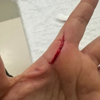 Balparmak Çıt Kapaklı Bal Kapağını Açarken Elime Kesik Geldi - Güvenlik İhlali