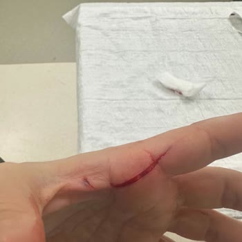 Balparmak Çıt Kapaklı Bal Kapağını Açarken Elime Kesik Geldi - Güvenlik İhlali