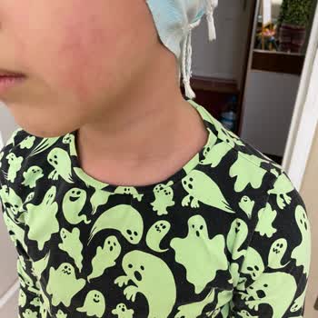 Sebamed Şampuanı Çocuğumda Yanık Benzeri Kızarıklıklara Yol Açtı