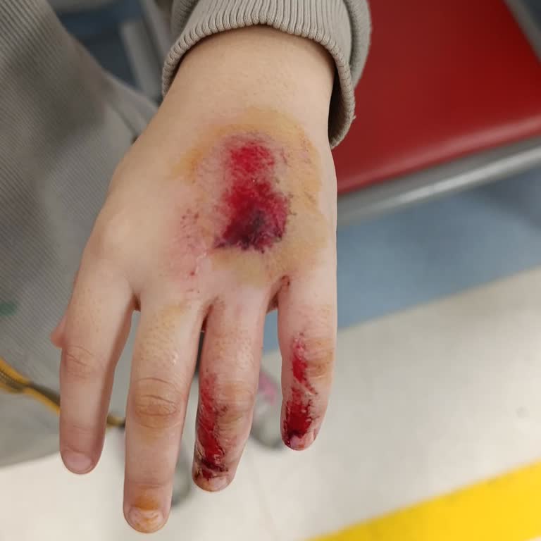 Magic World Eğlence Merkezi Görevlinin Sert İtmesi Sonucu Çocuğumun Elinde Ağır Zedelenme