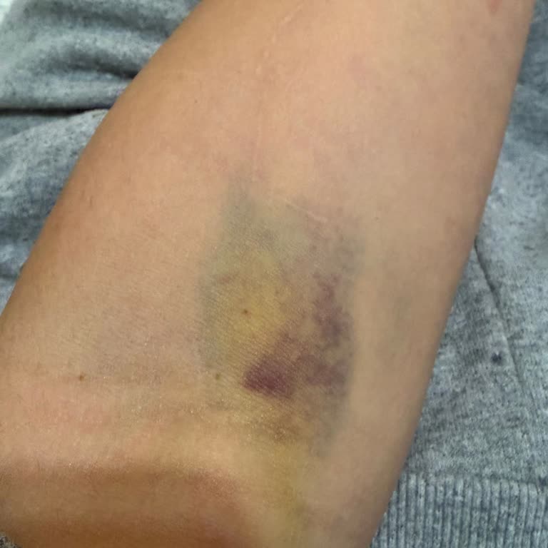 Kan Alma İşleminde Şiddetli Ağrı Ve Soğuk Personel Tutumu