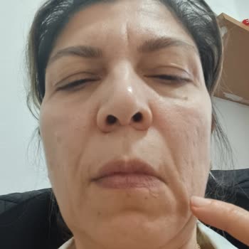 Dolgu Ve Eksozom Tedavisinde Asimetri, Çökme Ve İade Talebi