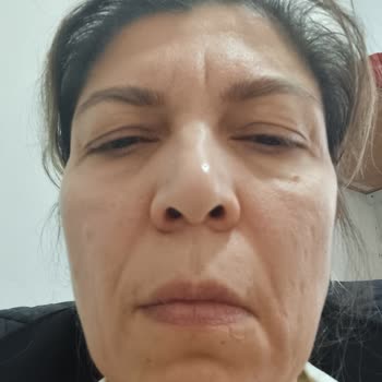 Dolgu Ve Eksozom Tedavisinde Asimetri, Çökme Ve İade Talebi