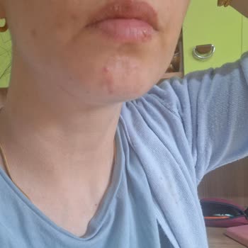 Sağlığımı Zedeleyen Kolajen Takviyesi İçin İade Ve Denetim Talebi