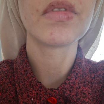 Sağlığımı Zedeleyen Kolajen Takviyesi İçin İade Ve Denetim Talebi