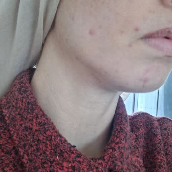 Sağlığımı Zedeleyen Kolajen Takviyesi İçin İade Ve Denetim Talebi