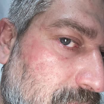 İpek Şampuanı Yüzümde Şiddetli Yanık Ve Kaşıntıya Neden Oldu, Tazminat Talebi