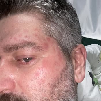 İpek Şampuanı Yüzümde Şiddetli Yanık Ve Kaşıntıya Neden Oldu, Tazminat Talebi