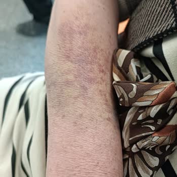 Kan Alımındaki Özensiz Davranış Annemin Kolunda Kalıcı Hasar Bıraktı