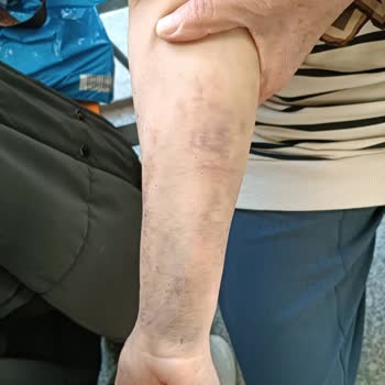 Kan Alımındaki Özensiz Davranış Annemin Kolunda Kalıcı Hasar Bıraktı