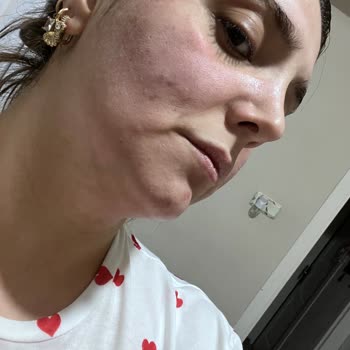 Nivea Care Canlandırıcı Yüz Temizleme Jelinde Ani Yanma Ve Şişme Şikayeti