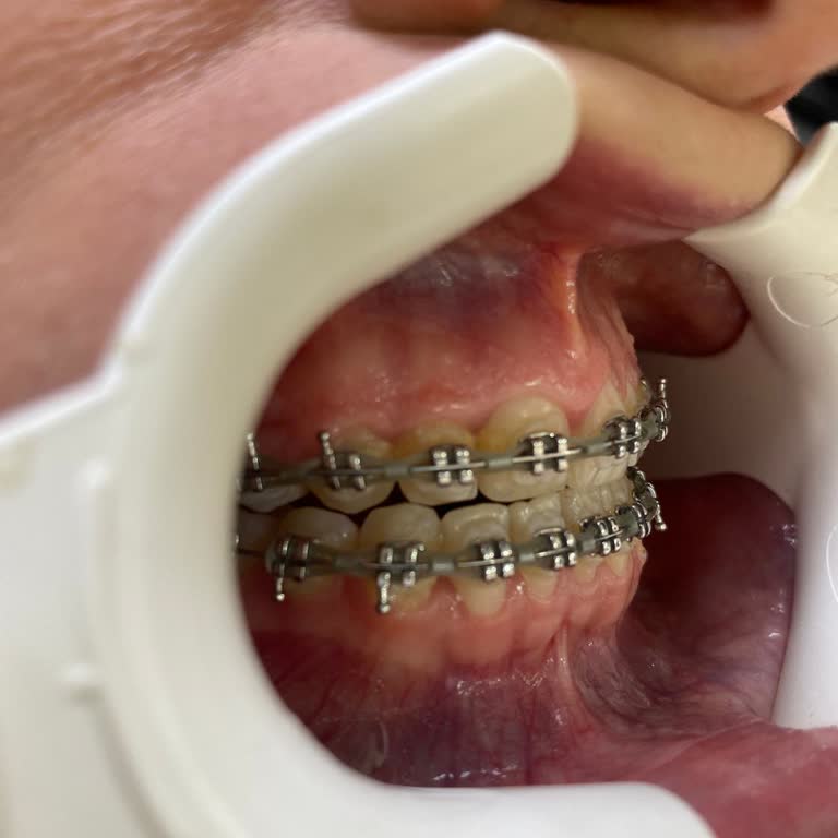 Diş Hekiminin Panoramik Film Çekmeden Uyguladığı Ortodonti Tedavisi Ve Mağduriyetim