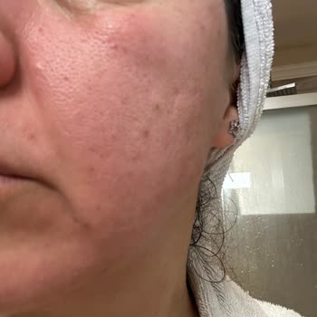 Yves Rocher Yüz Yıkama Jelinde Şiddetli Tahriş Ve İade Reddi