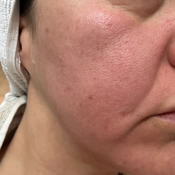 Yves Rocher Yüz Yıkama Jelinde Şiddetli Tahriş Ve İade Reddi