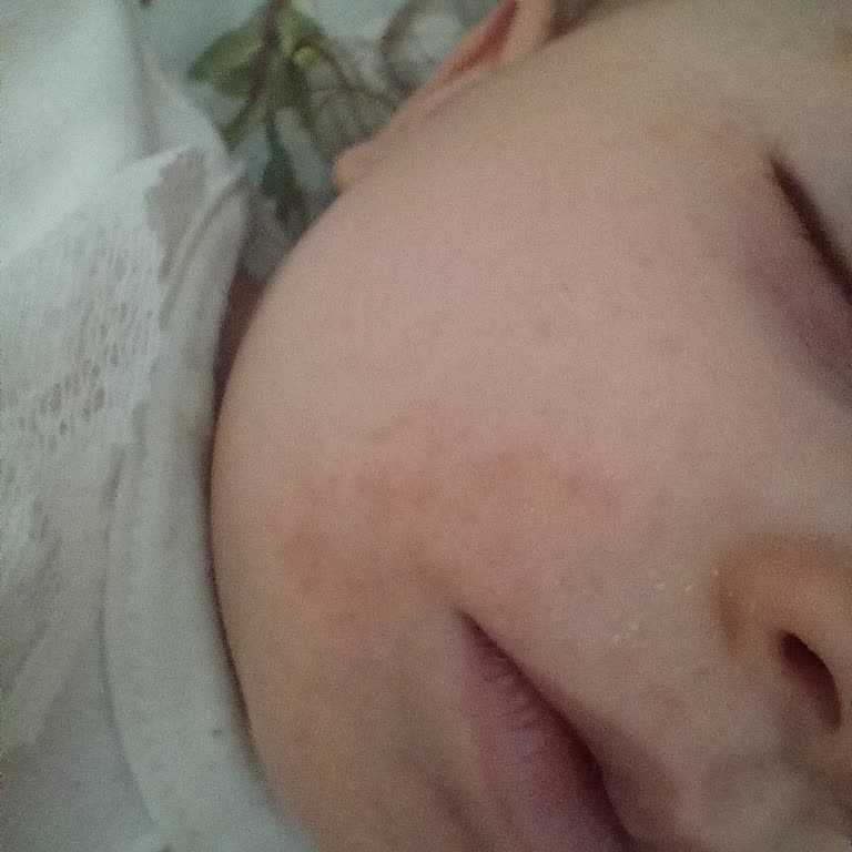 Aptamil 2'ye Geçişte Bebekte Şiddetli Alerji Ve Acil İnceleme Talebi