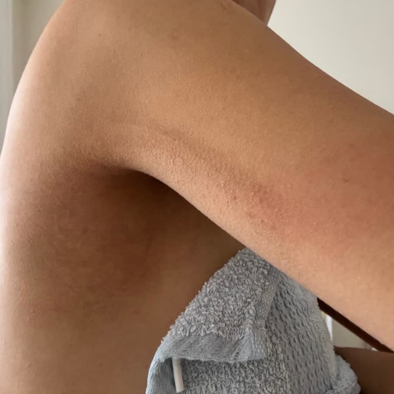 Lazer Epilasyon Yanıkları Ve Merkezin Cevapsız Tutumu