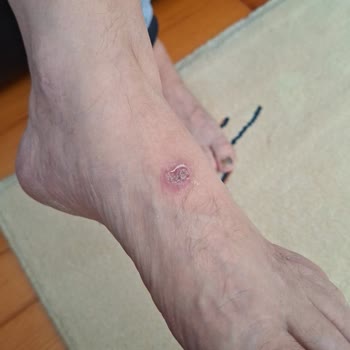 Ayakkabının Üst Kısmındaki Kusur Ayağımda Derin Yara Açtı