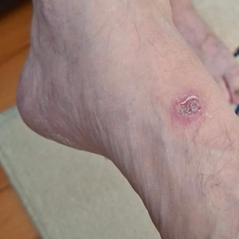 Cilt Tahrişi Ve Yara Oluşturan Ayakkabı İade Talebi Reddedildi