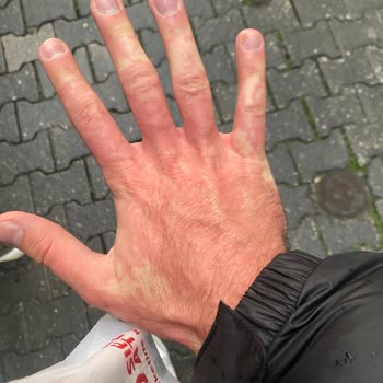 Sek Quark Peynirinde Şiddetli Alerjik Reaksiyon