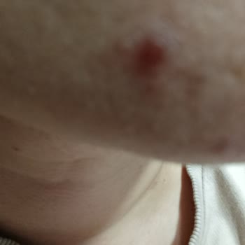 Schwarzkopf Saç Derimde Yanık Ve Aşırı Dökülme Yaşadım