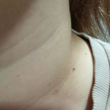 Schwarzkopf Saç Derimde Yanık Ve Aşırı Dökülme Yaşadım