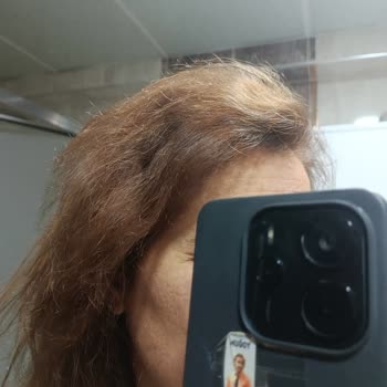 Schwarzkopf Saç Derimde Yanık Ve Aşırı Dökülme Yaşadım