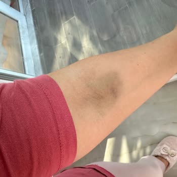 Sanko Üniversitesi Hastanesi Kan Alırken Damarı Patlattılar!