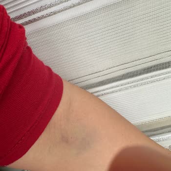 Sanko Üniversitesi Hastanesi Kan Alırken Damarı Patlattılar!