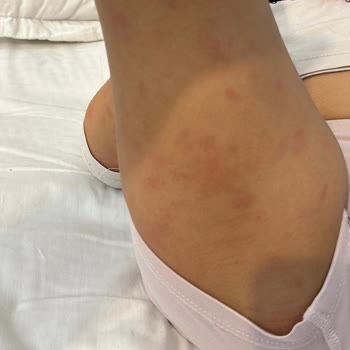 OMO Deterjanı Nedeniyle Çocuğumda Alerjik Reaksiyon Ve Tazminat Talebi