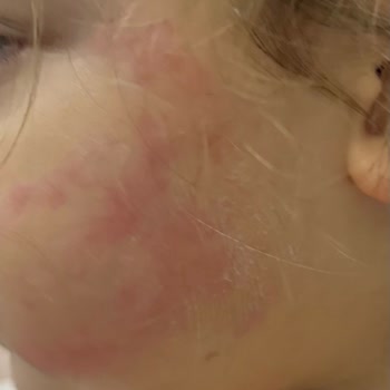 OMO Deterjanı Nedeniyle Çocuğumda Alerjik Reaksiyon Ve Tazminat Talebi