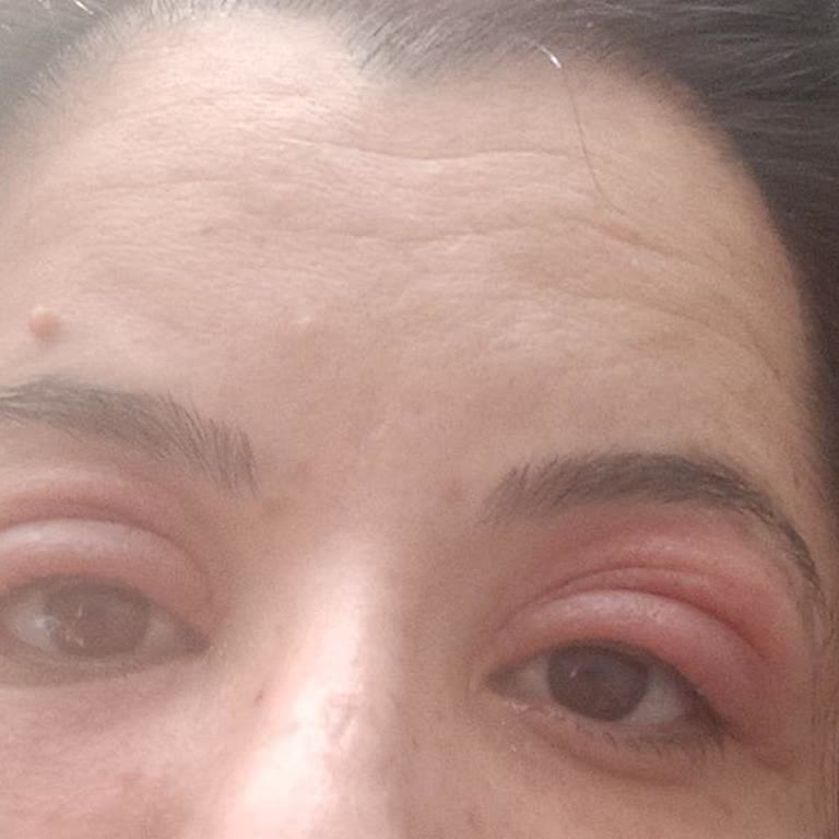 Garnier Aydınlatıcı Serumda Şiddetli Alerjik Reaksiyon Ve Görme Bozukluğu