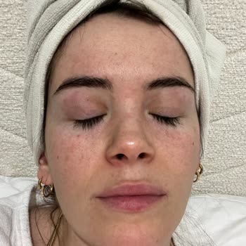 Yves Rocher Pure Mente Yüz Jelinde Ani Kızarıklık Ve Kabarıklık İadesi Talebi