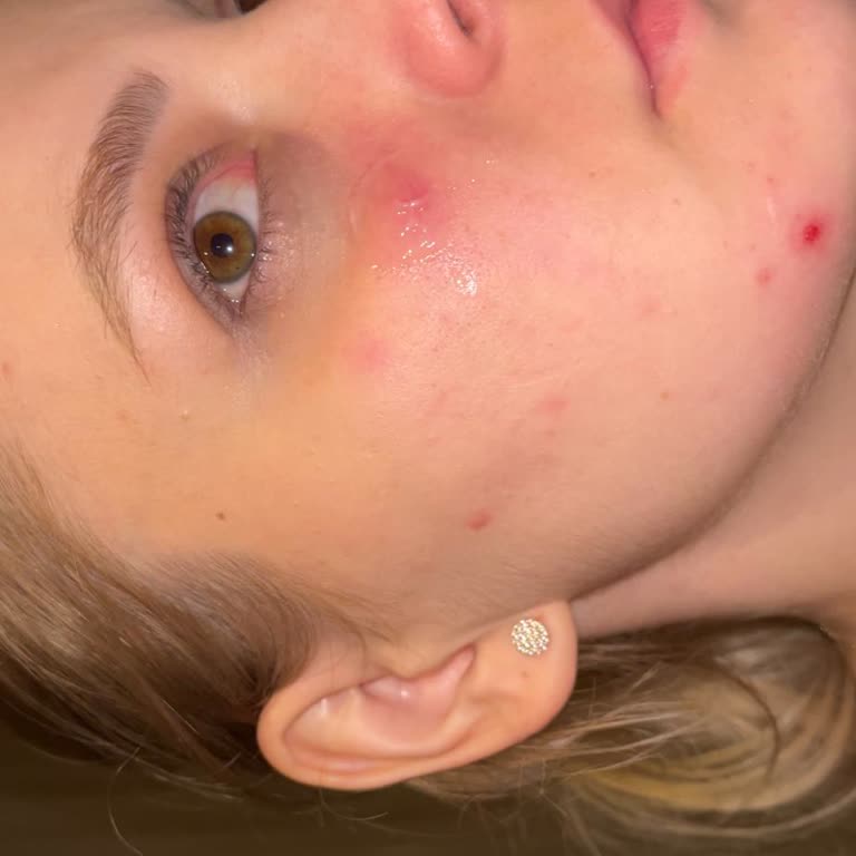 Sephora Şiddetli Cilt Tahrişi Ve Ağrılı Sivilcelerden Ücret İadesi Talebi